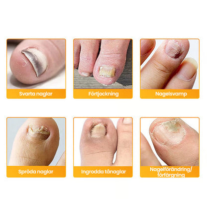 FungiShield™ Patches — Silent, Powerful Defense for Nails You’re Proud to Show Off