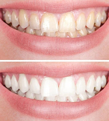 GlowBeam™ — Ignite Unstoppable Confidence with a Radiant, Pain-Free Smile