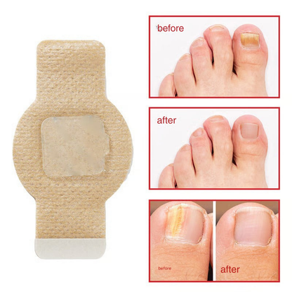 FungiShield™ Patches — Silent, Powerful Defense for Nails You’re Proud to Show Off