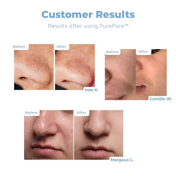 SilkClear™ — Banish Blackheads Deep Down for Radiant, Confidence-Boosting Skin