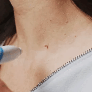 Silquease™ — Effortless Tag Removal That Restores Your Radiant Confidence Fast