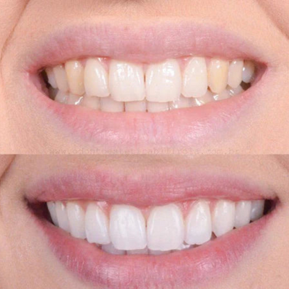 LumaShine™ — Ignite Instant Confidence with a Pain-Free, Brilliant Smile
