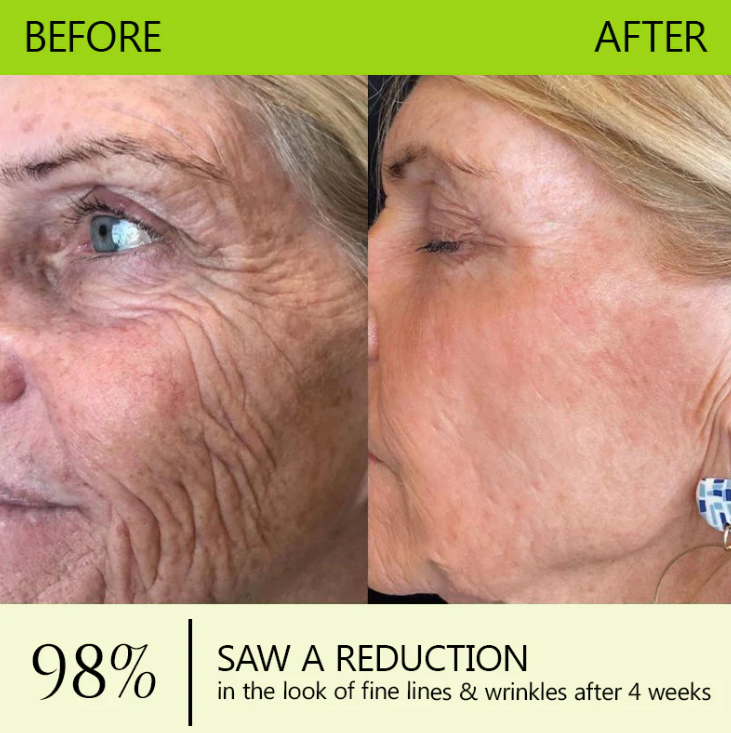 DermaVance™ — Unleash Youthful Lift and Radiance Without Needles or Pain