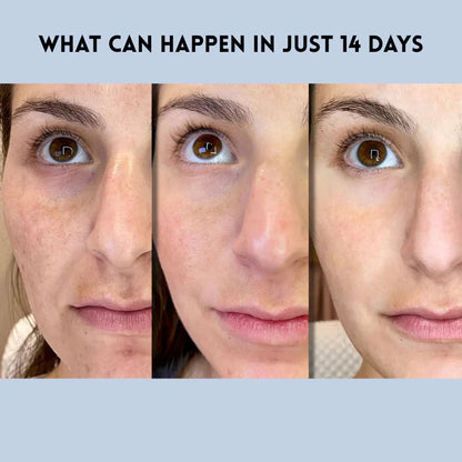 VelaLift™ — Instantly Restore Youthful Radiance and Confidence with a Feather-Light Lift