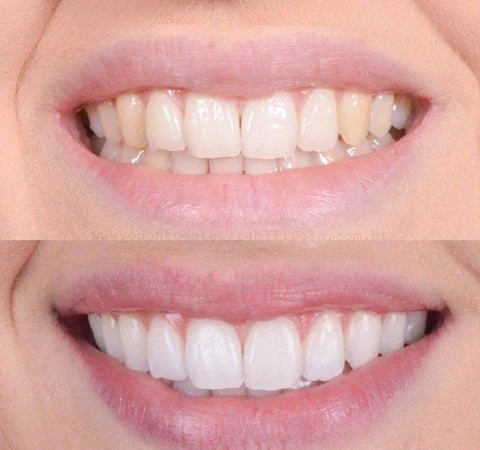 GlowBeam™ — Ignite Unstoppable Confidence with a Radiant, Pain-Free Smile