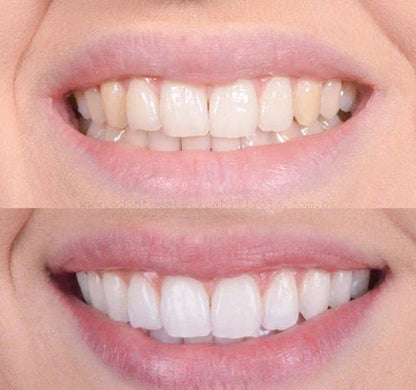 GlowBeam™ — Ignite Unstoppable Confidence with a Radiant, Pain-Free Smile