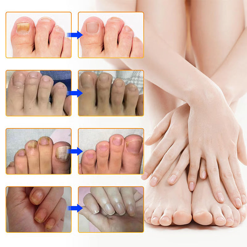 FungiShield™ Patches — Silent, Powerful Defense for Nails You’re Proud to Show Off