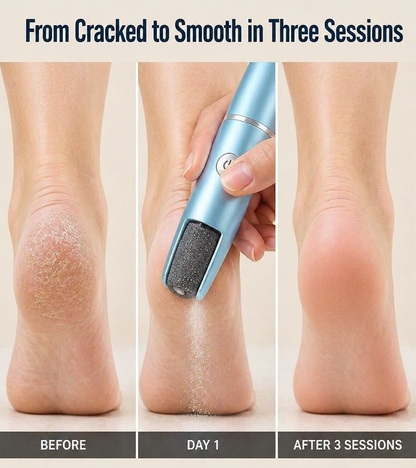 SoleSoft™ — Smooth Cracked Heels in 5 Minutes Without Scraping or Pain